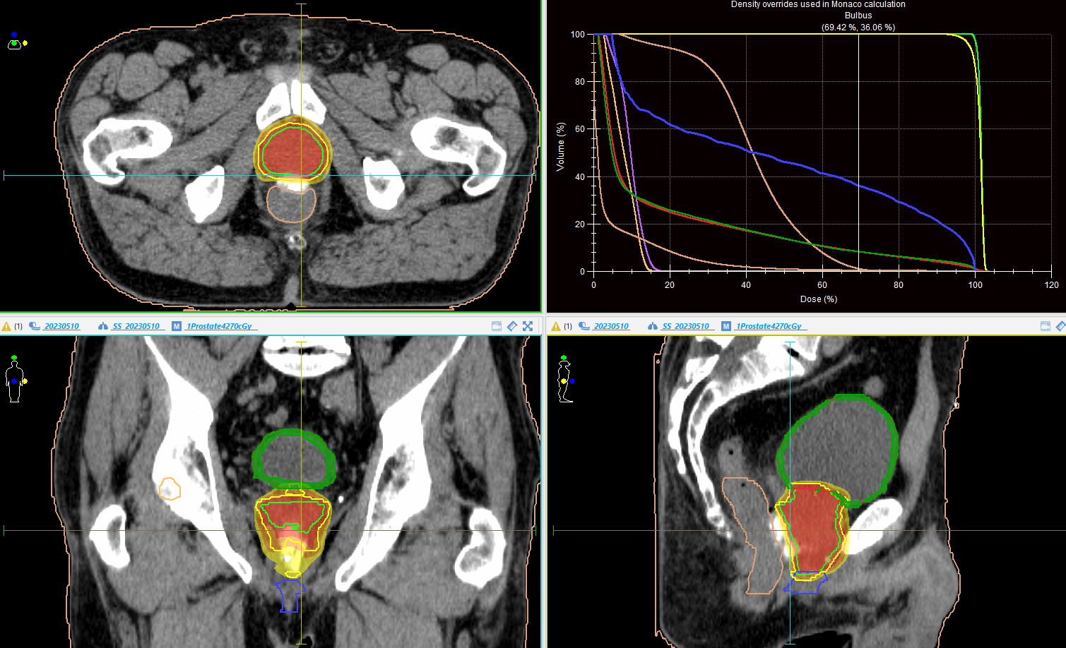 stereotactic-radiation-of-prostate-cancer-in-7-instead-of-39-sessions