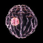 Radiotherapy Centre - brain cancer treatment