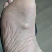 Radiotherapy centre - Ledderhose's disease on the bottom of a foot