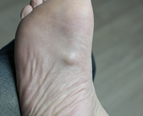 Radiotherapy centre - Ledderhose's disease on the bottom of a foot