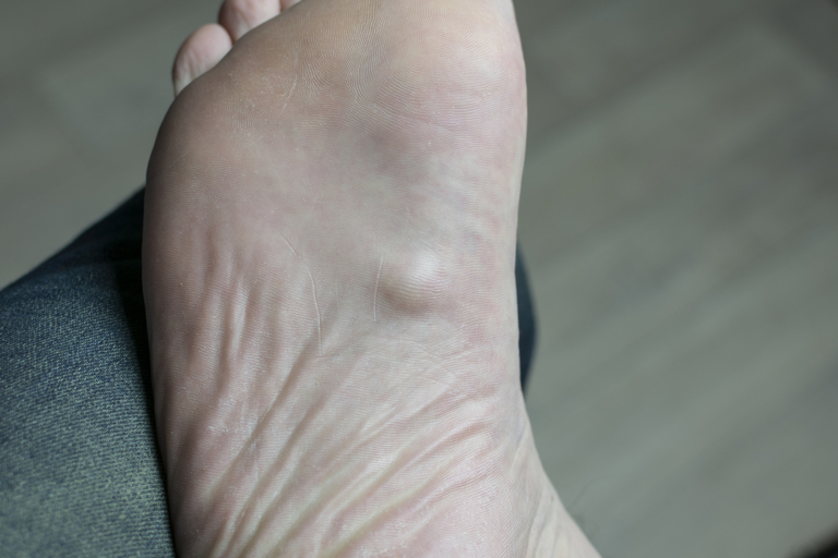 Radiotherapy centre - Ledderhose's disease on the bottom of a foot