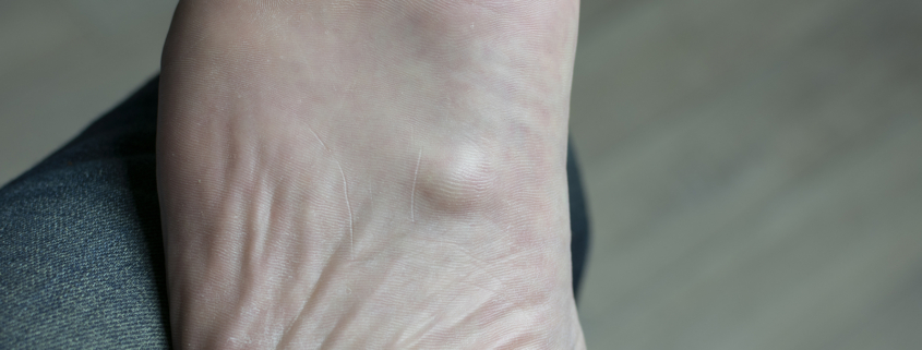 Radiotherapy centre - Ledderhose's disease on the bottom of a foot