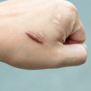 external radiotherapy - Keloid scar (Hypertrophic Scar) on man hand