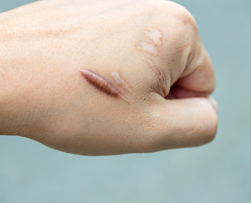 external radiotherapy - Keloid scar (Hypertrophic Scar) on man hand