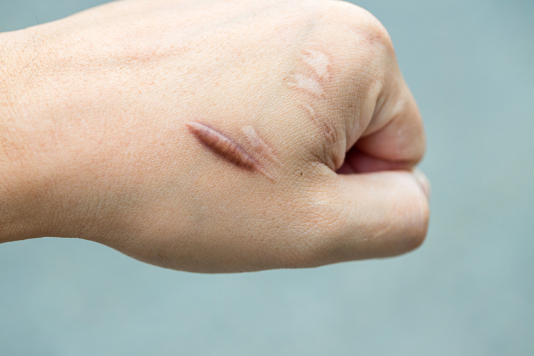 external radiotherapy - Keloid scar (Hypertrophic Scar) on man hand