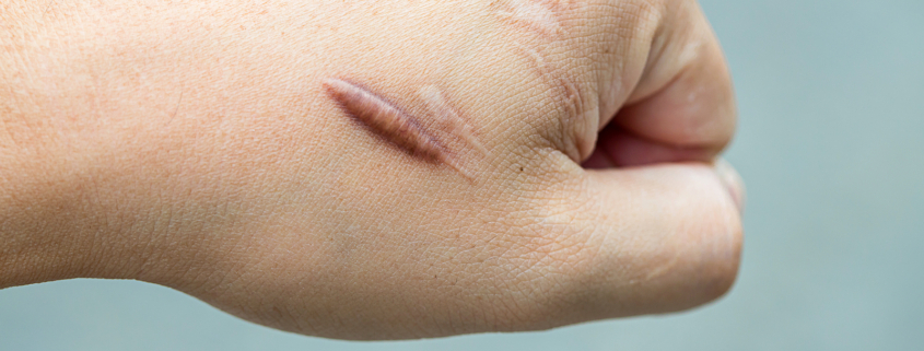 external radiotherapy - Keloid scar (Hypertrophic Scar) on man hand