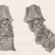 heterotope ossifikation